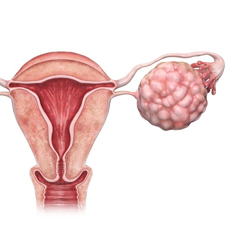 ilustracao-mostra-tumor-no-ovario-cancer-de-ovario-1605287025031_v2_1x1